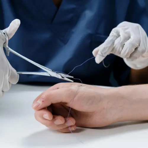 Suture removal